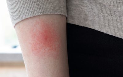 Malattia di Lyme: cause, sintomi, prevenzione, cure