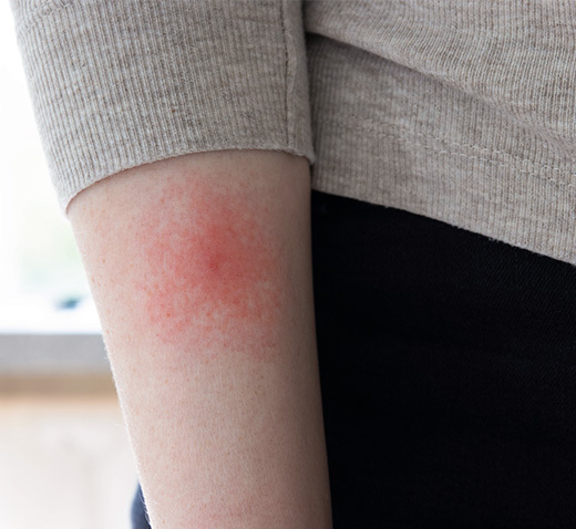 Malattia di Lyme: cause, sintomi, prevenzione, cure